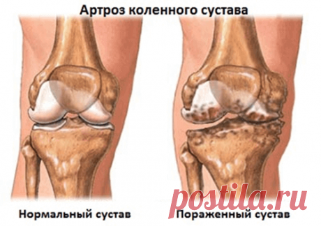 Вылечите суставы, пока вы не сели в инвалидное кресло! Запомните: артрит и артроз разрушают хрящевую ткань за 3 года