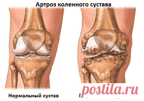 Вылечите суставы, пока вы не сели в инвалидное кресло! Запомните: артрит и артроз разрушают хрящевую ткань за 3 года