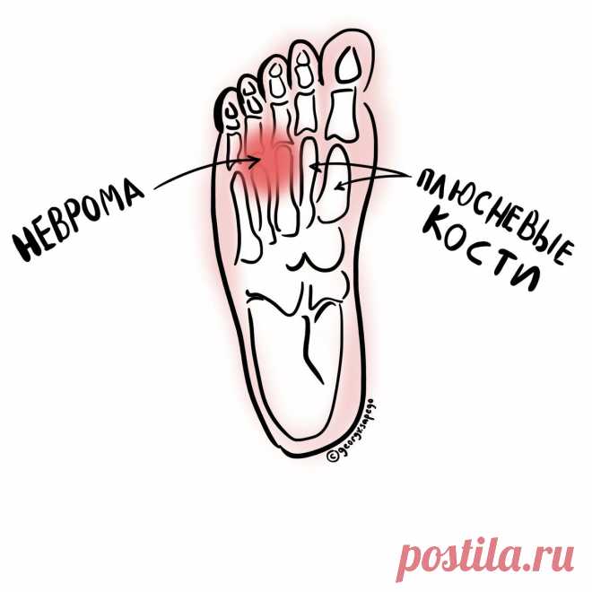 Неврома Мортона | Для пациентов | Яндекс Дзен