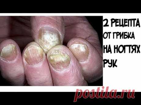 (2) ШОК!!!Эти два рецепта помогут избавиться от грибка на ногтях рук - YouTube