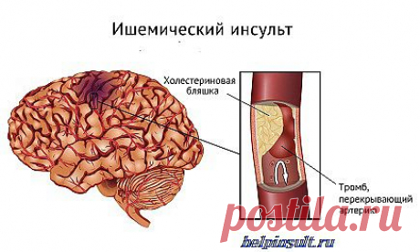 Симптомы ишемического инсульта
