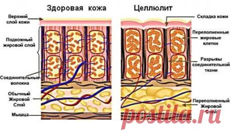 Токсины, на выход: как проститься с целлюлитом | Golbis