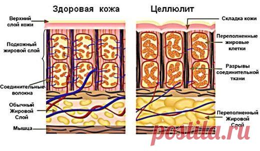 Токсины, на выход: как проститься с целлюлитом | Golbis