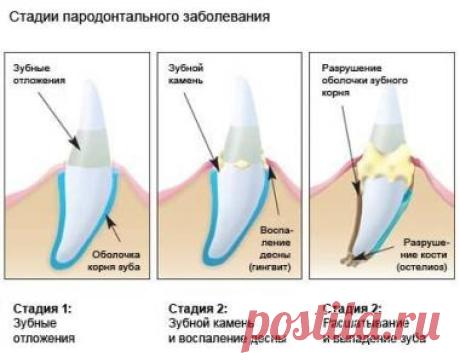 Народная медицина против пародонтоза