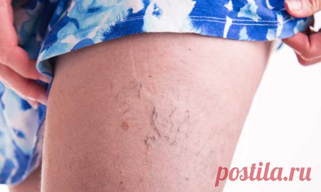 Сосудистые «звездочки» на ногах: избавляемся просто и надежно. Рецепты от усталости ног Порой на коже ног появляются красноватые прожилки как следствие расширения мелких вен, находящихся в слое кожи. Эти образования получили название сосудистые «звездочки».


Почему появляются «звездочки…