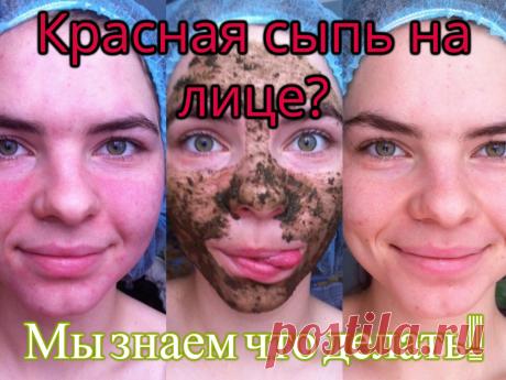 Красная сыпь на лице? Мы знаем как от нее избавиться!