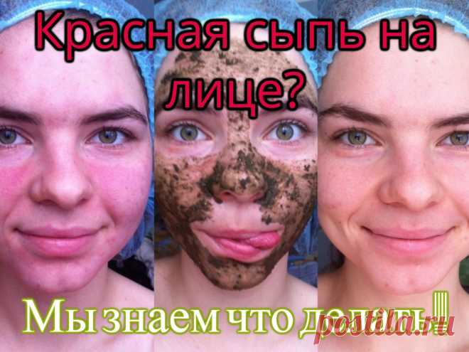 Красная сыпь на лице? Мы знаем как от нее избавиться!