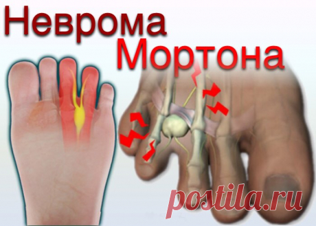 doclvs.ru | Неврома Мортона: симптомы, диагностика, лечение