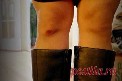 Бабушкины советы. Ушибы и гематомы (синяки)