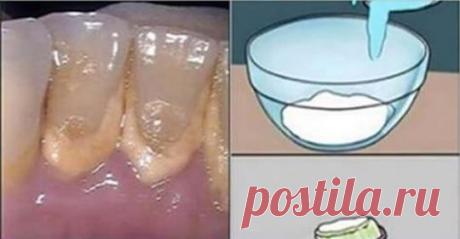 Розчин для видалення зубного каменю всього за 2 хвилини!