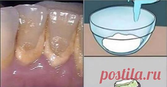 Розчин для видалення зубного каменю всього за 2 хвилини!