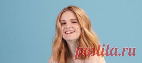 Комплексы в прошлом: девушка с пятнами по всему телу стала моделью... нижнего белья Марика Нэги доказала – на пути к мечте нет ничего невозможного.