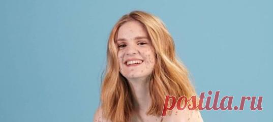 Комплексы в прошлом: девушка с пятнами по всему телу стала моделью... нижнего белья Марика Нэги доказала – на пути к мечте нет ничего невозможного.