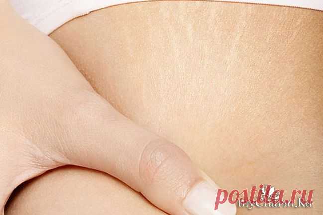 Домашние способы борьбы со стриями: Группа Уход за кожей