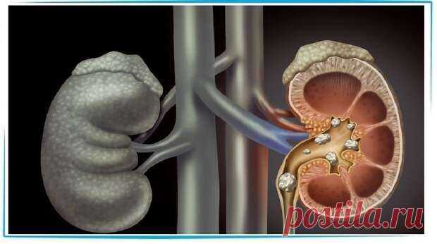 2 домашних средства, которые растворят камни в почках и желчном. Эффективный безоперационный метод | Краше Всех Простые натуральные средства эффективно растворяют камни! Узнайте эти рецепты! Острые камни спускаются по тонкой трубке или мочеточнику, ведущему от почек к мочевому пузырю, а затем из мочевого пузыря