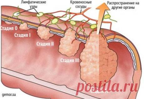 Наше здоровье Будьте здоровы вместе с нами  Рак прямой кишки.