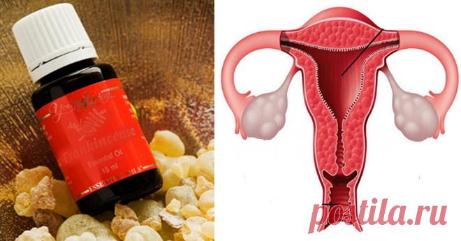 Новые исследования доказали: ладан сильнее, чем химиотерапия в убийстве рака яичников и не только!