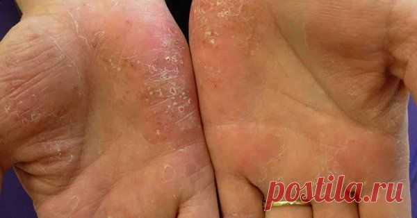 Ладонно-подошвенный псориаз: фото, лечение