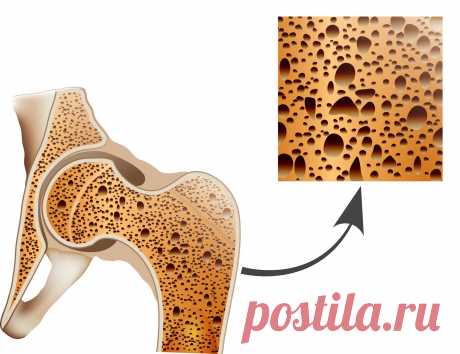 Эндопротезы zimmer в эндопротезировании шейки бедра