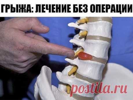 ПОЯСНИЧНАЯ ГРЫЖА ЛЕЧИТСЯ НАРОДНЫМИ СПОСОБАМИ
Поясничная грыжа – это болезнь серьезная! Поясничная грыжа может «напасть», как на молодого человека, так и на пенсионера. От возраста это совершенно не зависит. Люди с поясничной грыжей встречаются и двадцатилетние, и шестидесяти пятилетние.
Поясничная грыжа доставляет очень большие страдания. Постоянная боль не дает нормально жить! Даже шагнув на одну ступеньку, уже хочется вскрикнуть от боли, что уже говорить о том, чтобы подняться, например, на