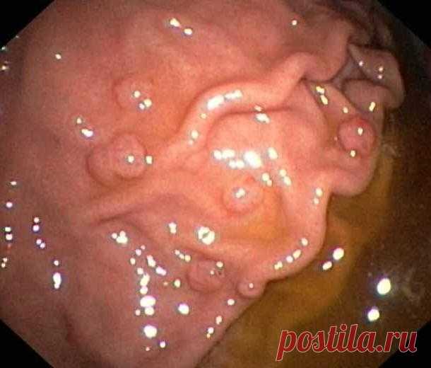 Что такое полипы в желудке, как их лечить Полипом называют разновидность доброкачественной опухоли в форме уплотнения на ножке, происходящей из эпителиальной ткани слизистой желудка. Чаще всего полипы в желудке провоцируются воспалительными процессами органа. Их средний размер варьируется от полутора до трех сантиметров. Внешне они похожи на гладкие шарики или характеризуются множеством сегментов, напоминающих цветную капусту.
