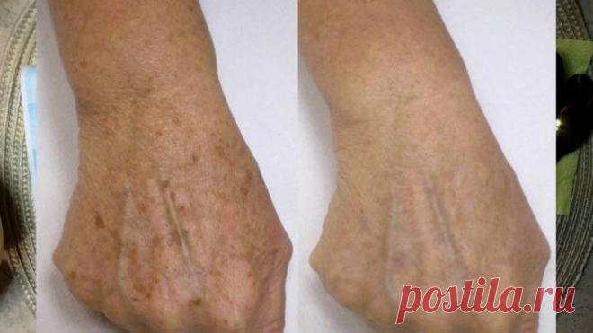 Как отбелить пигментные пятна на коже рук и лице / Домоседы