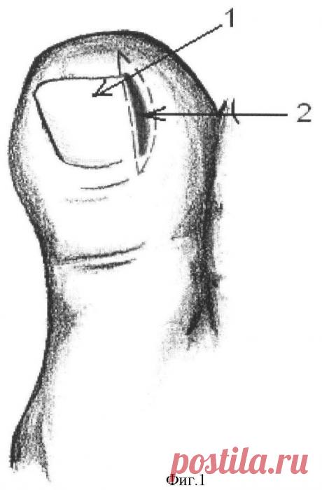 Способ комплексного лечения вросшего ногтя. Патент РФ 2448657