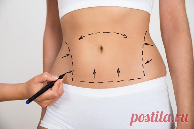 Липоабдоминопластика: что это, особенности процедуры