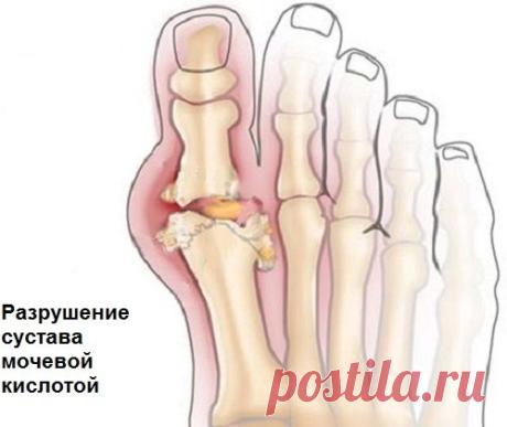 В чем заключается опасность мочевой кислоты и как можно уменьшить ее количество? - Шаг к Здоровью