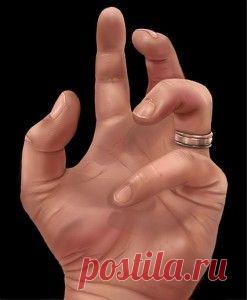 Ох, уж эти наросты!.. на суставах.