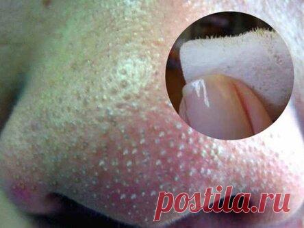 Один простой трюк, который поможет навсегда забыть о черных точках