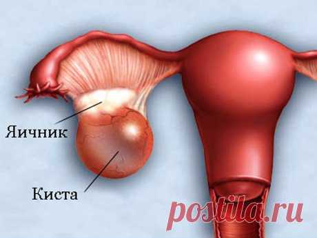 Сенсация! Это средство вылечит любую кисту! Подробнее смотри в нашем видео!