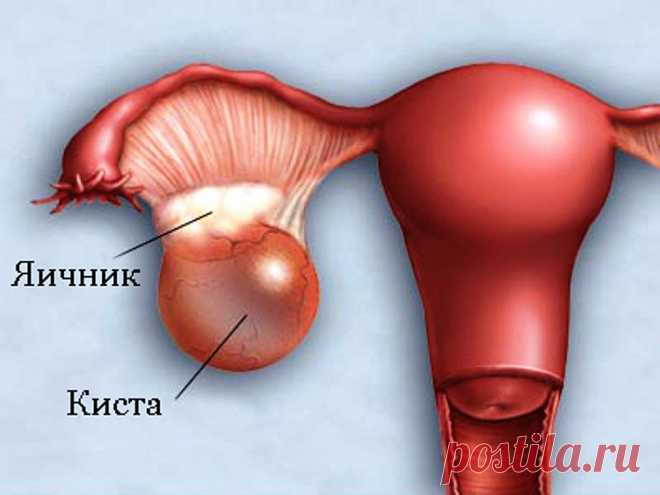 Сенсация! Это средство вылечит любую кисту! Подробнее смотри в нашем видео!
