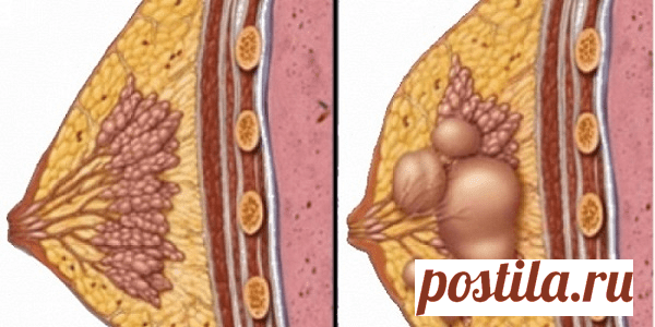 Вы не должны ложиться под нож: Лечение любых видов кист теперь возможно с этим рецептом! — Полезные советы