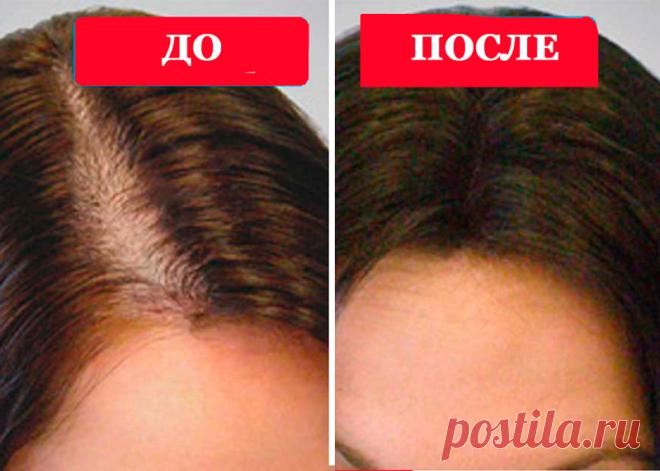 Живица – уникальное чудо-средство от выпадения волос | Всегда в форме!