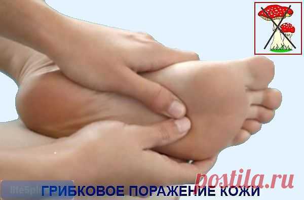 Эпидермофития: виды, причины возникновения, лечение |