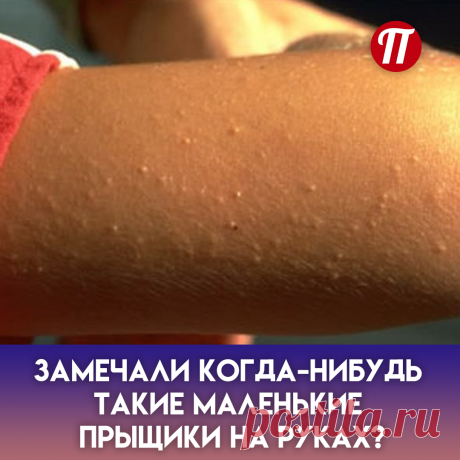Их появление связывают с гормональными нарушениями, дисбактериозом, заболеванием внутренних органов, реакцией на стрессовые ситуации... Это негативное явление может быть также следствием или симптомом псориаза, кори, краснухи, дерматита, дисгидроза.