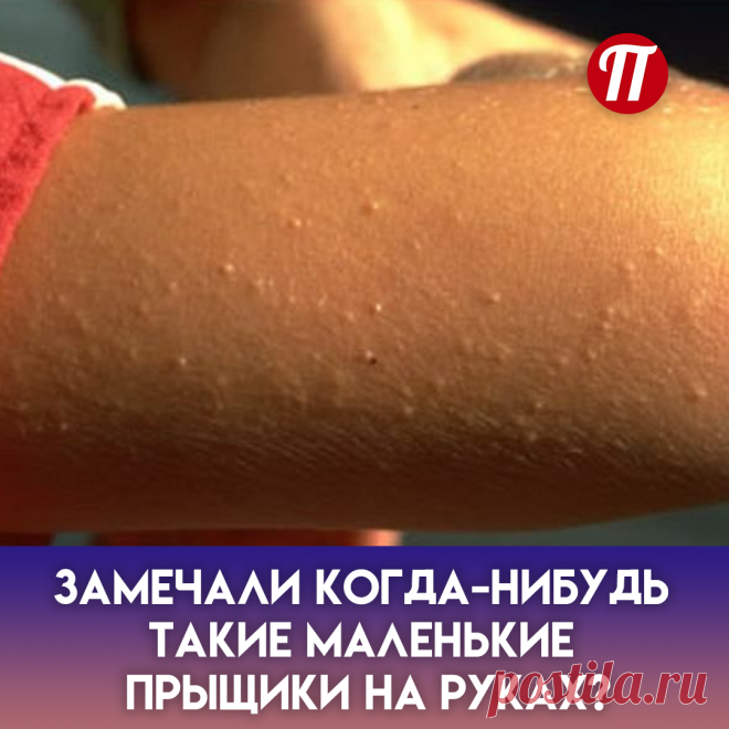 Их появление связывают с гормональными нарушениями, дисбактериозом, заболеванием внутренних органов, реакцией на стрессовые ситуации... Это негативное явление может быть также следствием или симптомом псориаза, кори, краснухи, дерматита, дисгидроза.