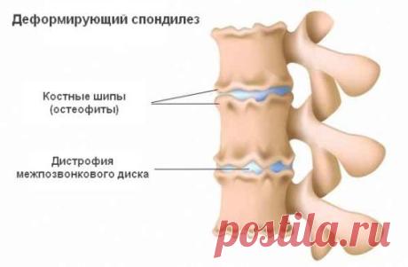 Деформирующий спондилез шейного, грудного, поясничного отделов позвоночника: симптомы и лечение