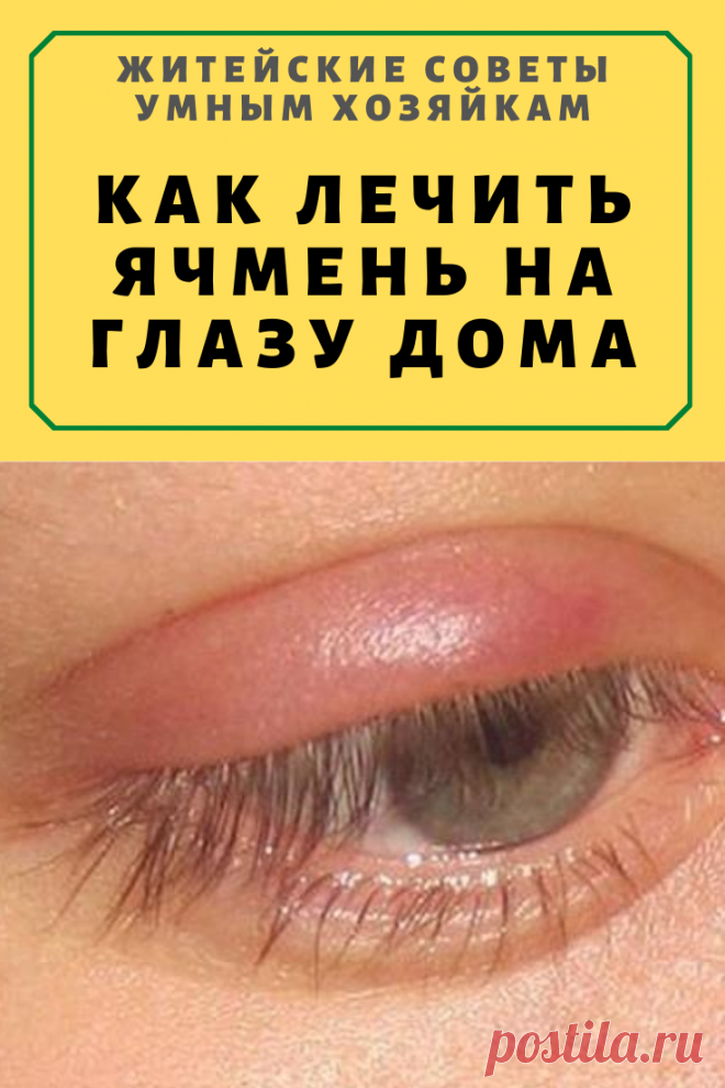 Как лечить ячмень на глазу дома народными средствами и лекарственными препаратами | Житейские Советы