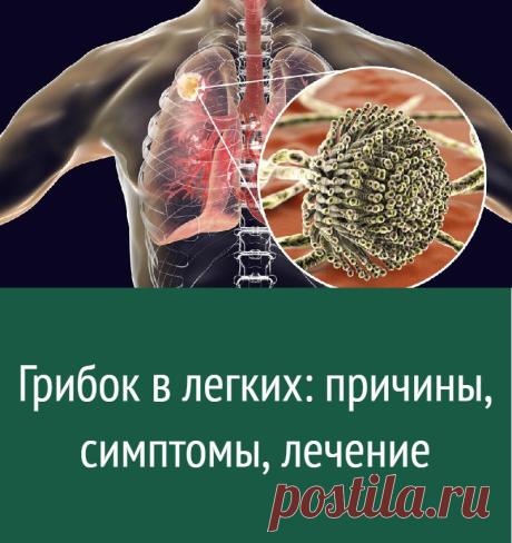 Грибок в легких: причины, симптомы, лечение