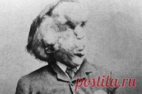 Урод с красивой душой: история Джозефа Меррика — Человека-слона Он был звездой шоу уродов Викторианской эпохи и человеком с самой деформированной внешностью в истории. Медики пытались раскрыть загадку Джозефа Меррика (Joseph Merrick) вплоть до его смерти в 1890 году...