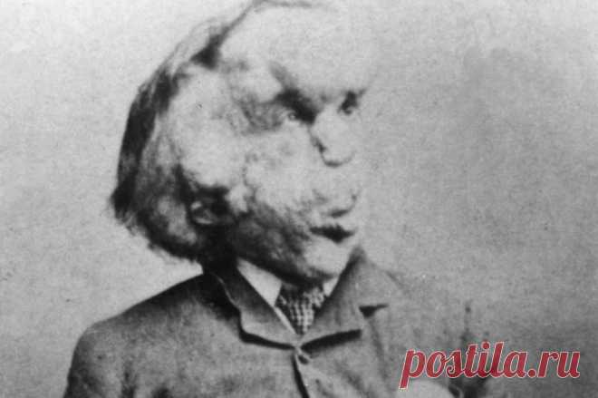 Урод с красивой душой: история Джозефа Меррика — Человека-слона Он был звездой шоу уродов Викторианской эпохи и человеком с самой деформированной внешностью в истории. Медики пытались раскрыть загадку Джозефа Меррика (Joseph Merrick) вплоть до его смерти в 1890 году...