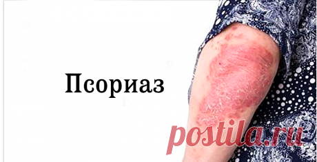 Симптомы псориаза и 5 естественных процедур! - Стильные советы