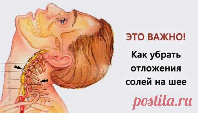 Убираем отложения солей на шее Отложение солей на шее называют остеохондрозом шейного отдела позвоночника. Вследствие того, что шейный отдел позвоночника является весьма важной частью организма, нарушения в этой области приводят к …