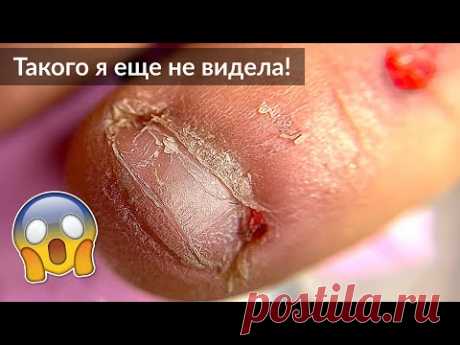 Очень Обгрызенные ногти / Проблемная кутикула - Маникюр и Наращивание