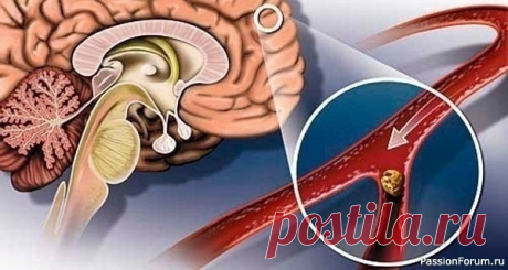 Улучшаем кровообращение народными средствами Гипертония и атеросклероз &mdash; две основные причины, приводящие к нарушению мозгового кровообращения.&nbsp;Именно из-за них развивается паралич, падает зрение, теряется координация, нарушается движение, возникает инсульт.&nbsp;Хронические сосудистые заболевания мозга называются...