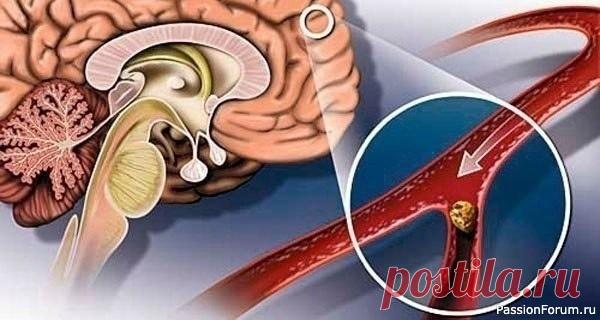 Улучшаем кровообращение народными средствами Гипертония и атеросклероз — две основные причины, приводящие к нарушению мозгового кровообращения. Именно из-за них развивается паралич, падает зрение, теряется координация, нарушается движение, возникает инсульт. Хронические сосудистые заболевания мозга называются...