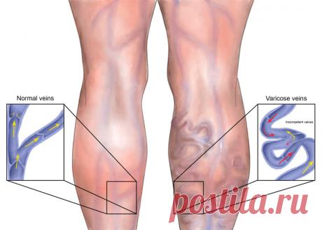 Борьба с варикозным расширением вен Варикозным расширением вен страдают многие. Зачастую причиной такого недуга служит слабая венозная сетка, но иногда развитие заболевания обусловлено наследственностью.