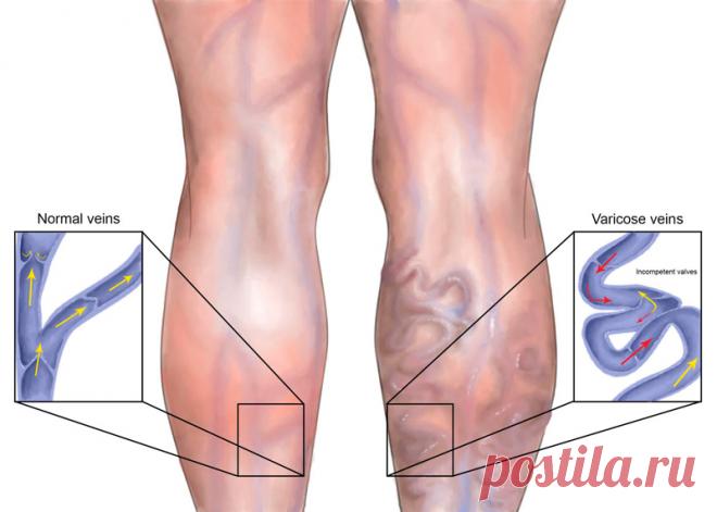 Борьба с варикозным расширением вен Варикозным расширением вен страдают многие. Зачастую причиной такого недуга служит слабая венозная сетка, но иногда развитие заболевания обусловлено наследственностью.